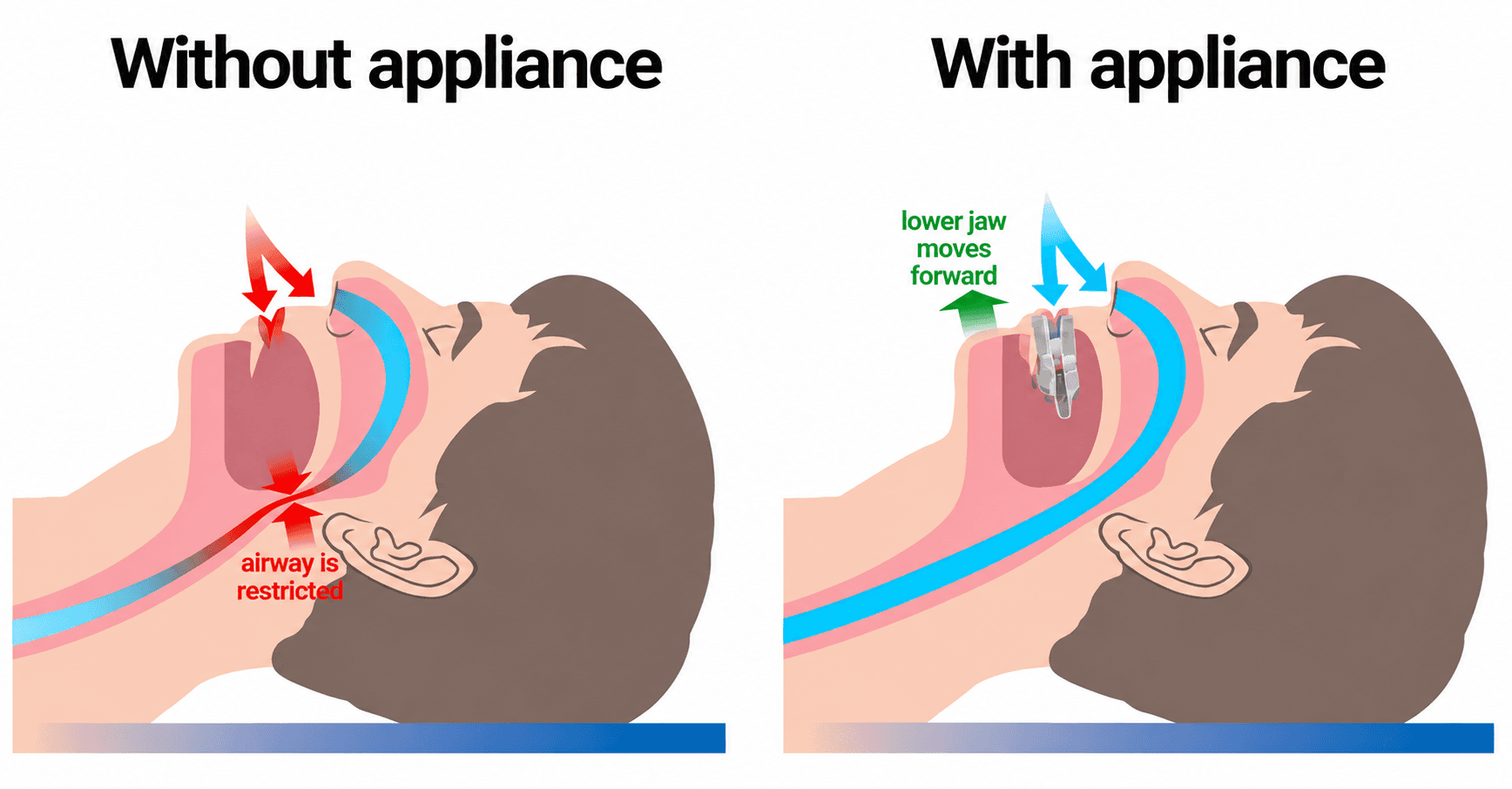 Sleep apnea treatment appliance at Broadway Dental