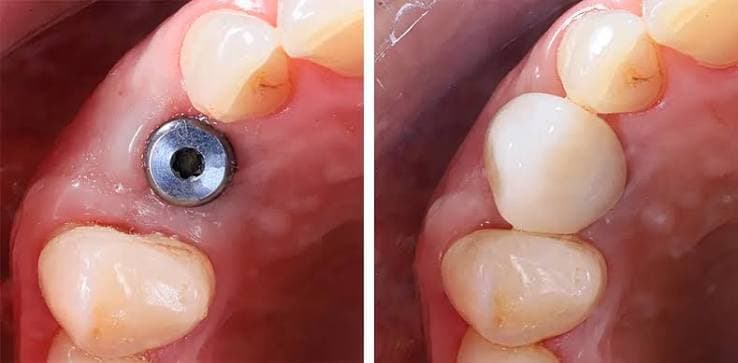 Dental implant at Broadway Dental