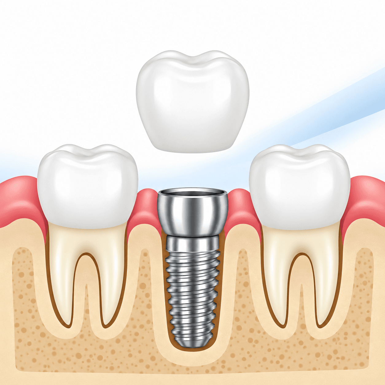Dental implants at Broadway Dental in Northeast Minneapolis