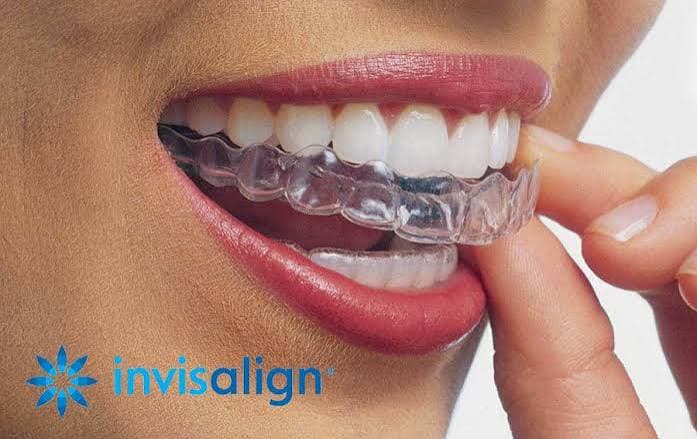 Invisalign treatment at Broadway Dental