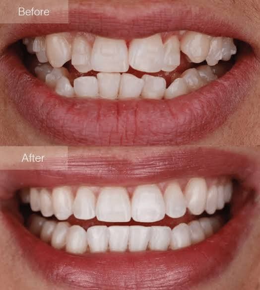 Invisalign clear aligners at Broadway Dental