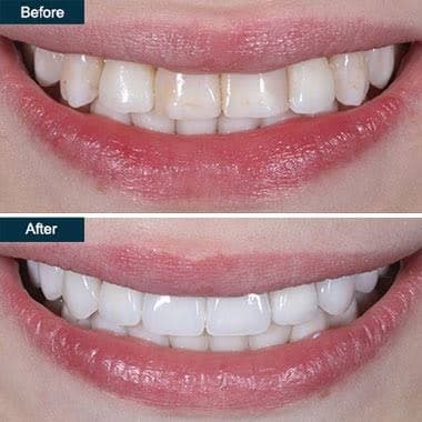 Beautiful smile — cosmetic whitening at Broadway Dental
