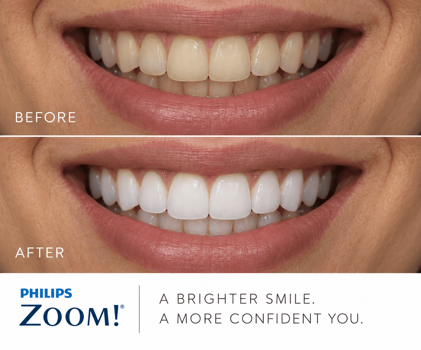 Zoom!® In-Office Whitening